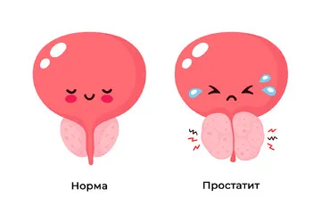Лечение острого простатита в Липецке
