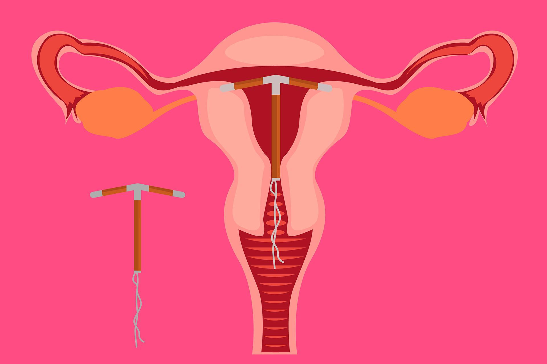 Установка и введение внутриматочной спирали внутриматочного контрацептива - ООО «Качество Жизни»